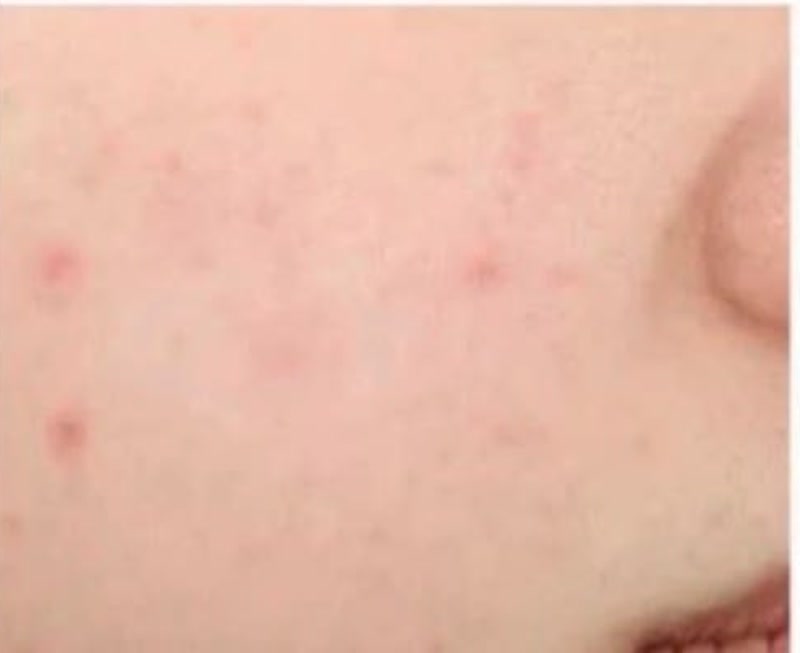 Peau avant l'utilisation du filtre de douche NEMO